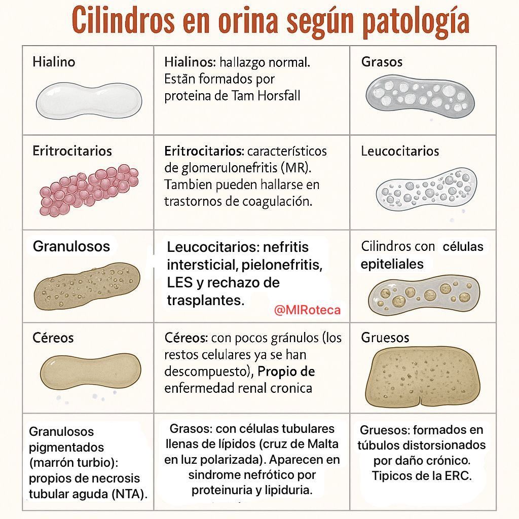 Cilindros urinarios según la patología