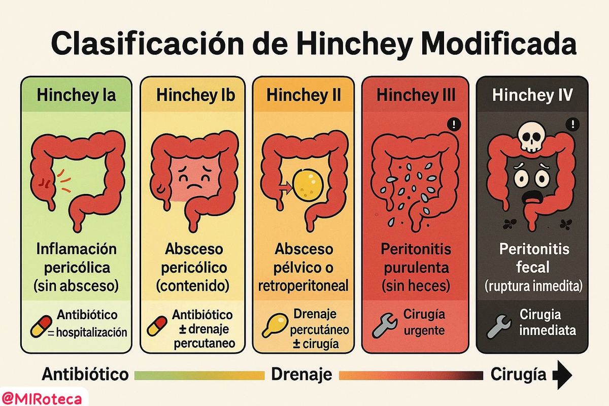 Clasificación de Hinchey (diverticulitis) · viñeta MIR