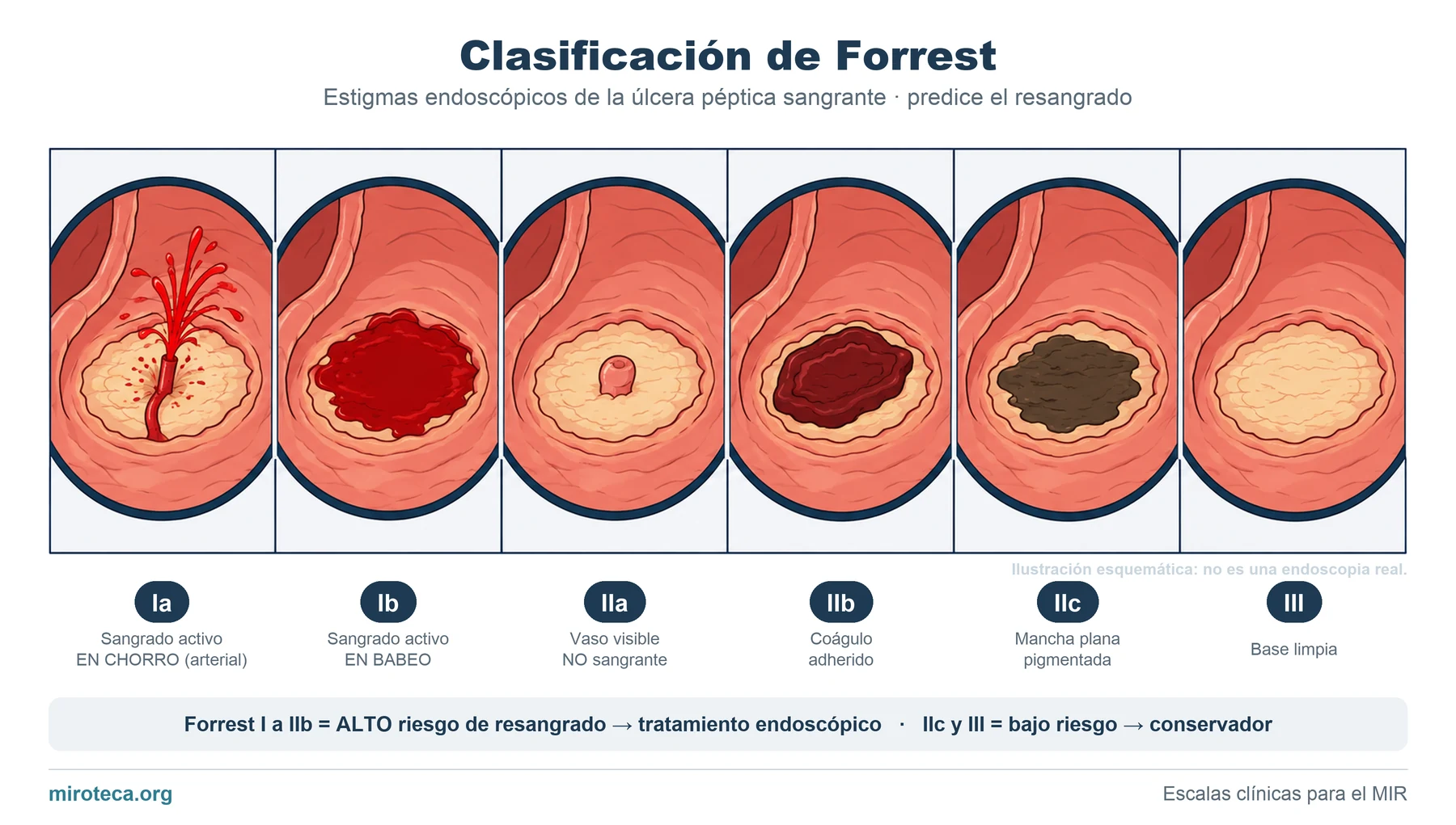 Clasificación de Forrest: los estigmas endoscópicos de la úlcera péptica sangrante, de Ia (sangrado en chorro) a III (base limpia), ilustrados uno a uno