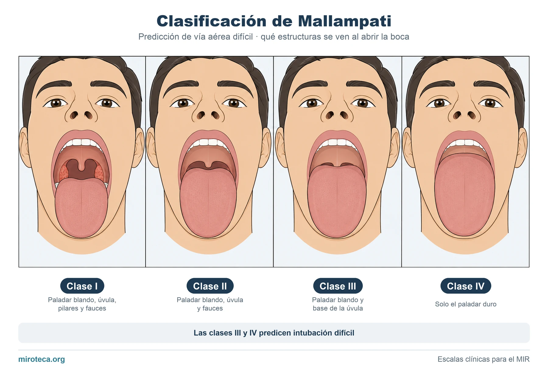 Clasificación de Mallampati: las 4 clases según las estructuras que se ven al abrir la boca, del paladar blando con úvula y pilares hasta ver solo el paladar duro